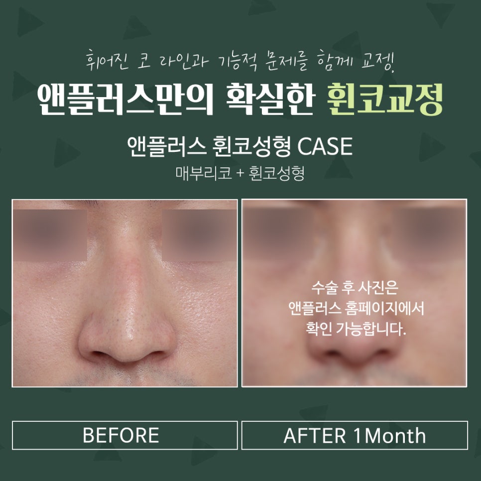 A Thorough Analysis for Reliable Crooked Nose Correction Reviews image 9