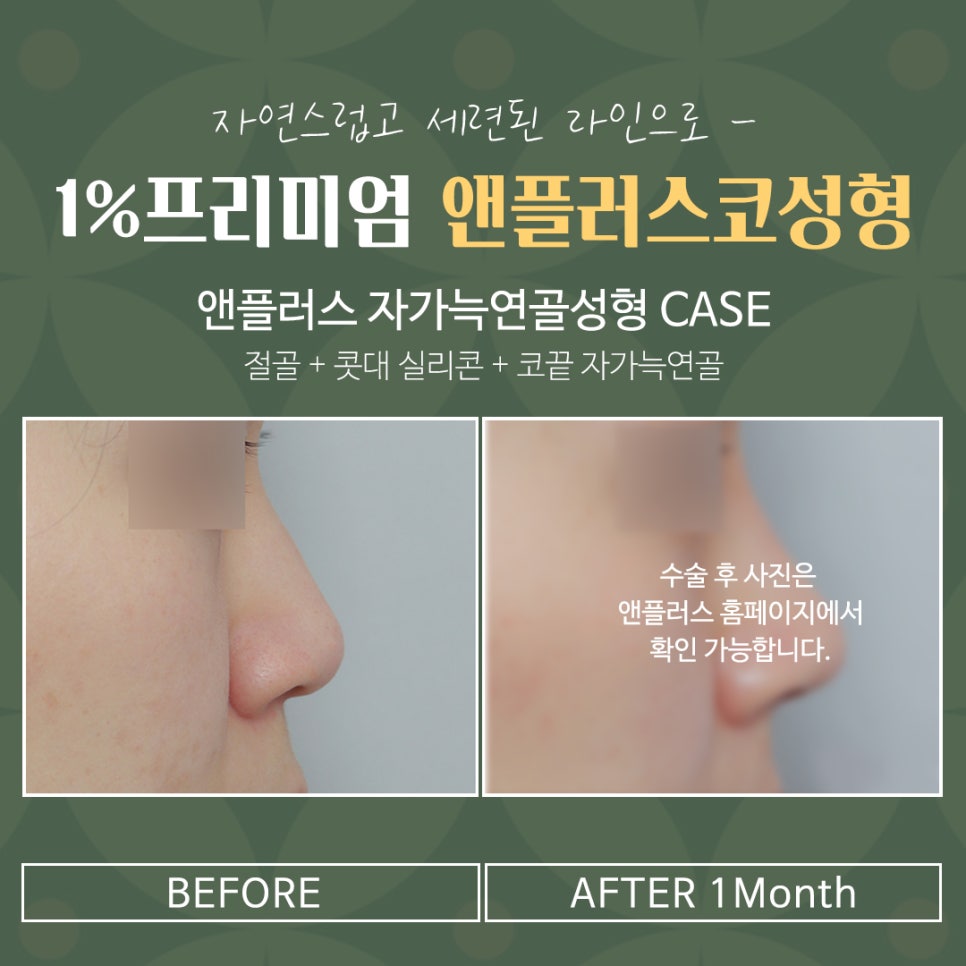자가늑연골코수술 기능까지 생각해서 관련 이미지 16