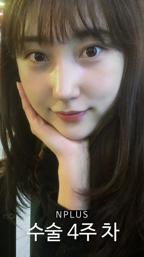 앤플러스에서 진행된 매부리코성형후기 관련 이미지 7