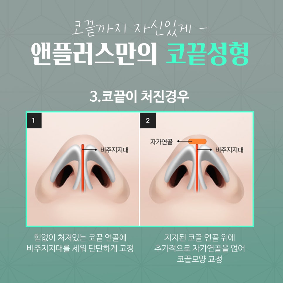 Improving the line through tip cartilage suturing image 9