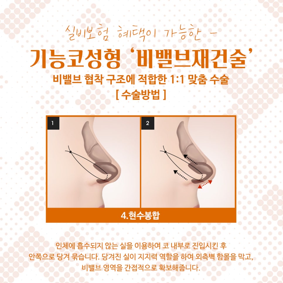 비밸브협착증 코수술방법 완벽 정리 관련 이미지 12