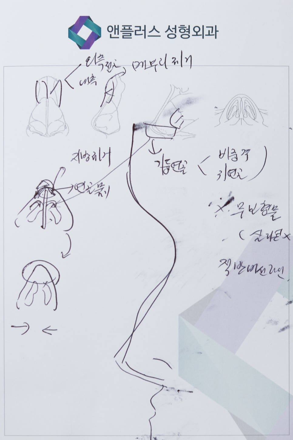 남자 복코와 매부리코 수술 후기 관련 이미지 5