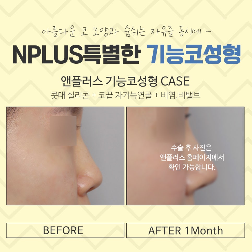 A Clear Choice for Rhinitis Nose Surgery image 15