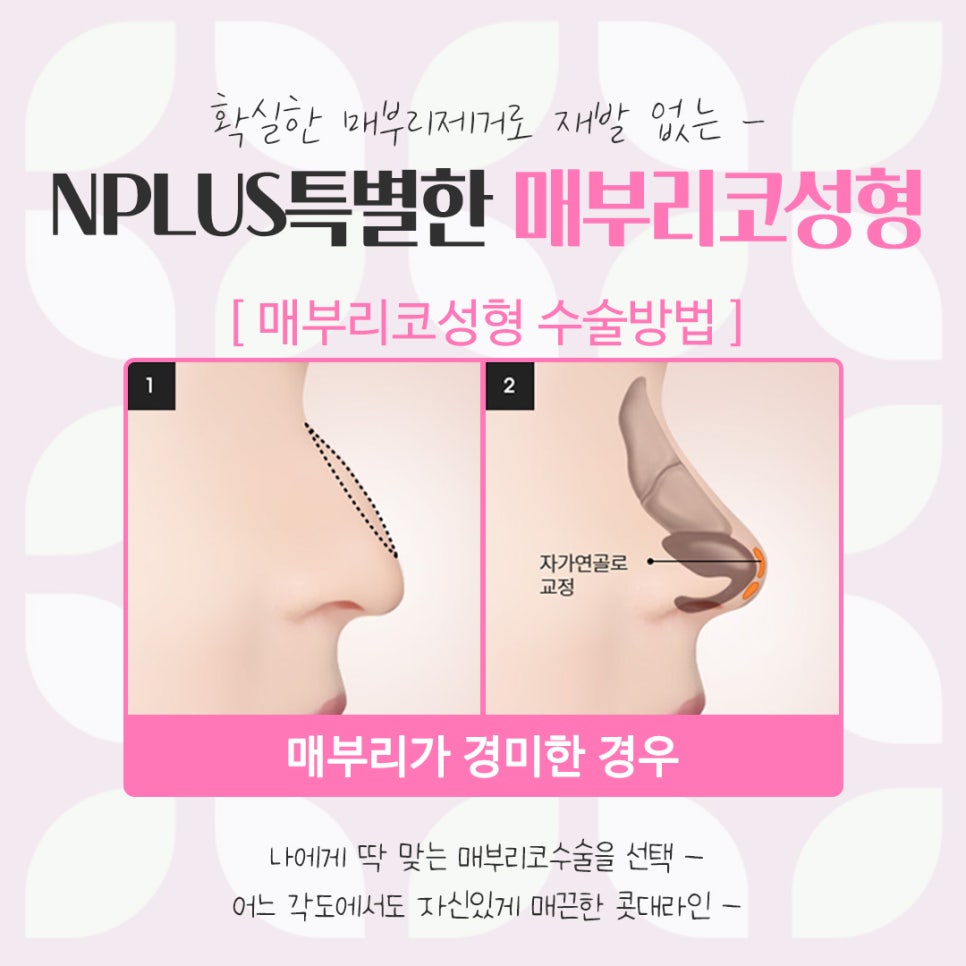 매부리코성형후기를 통해 이미지 개선 관련 이미지 11