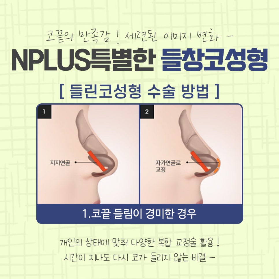 Significantly Improve an Upturned Nose with Surgery image 8