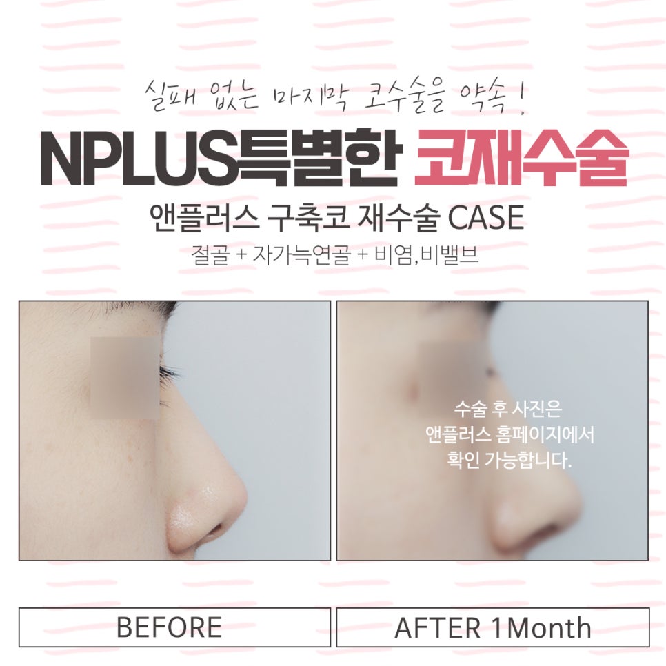 Checking the Results of a Revision Rhinoplasty Clinic image 12