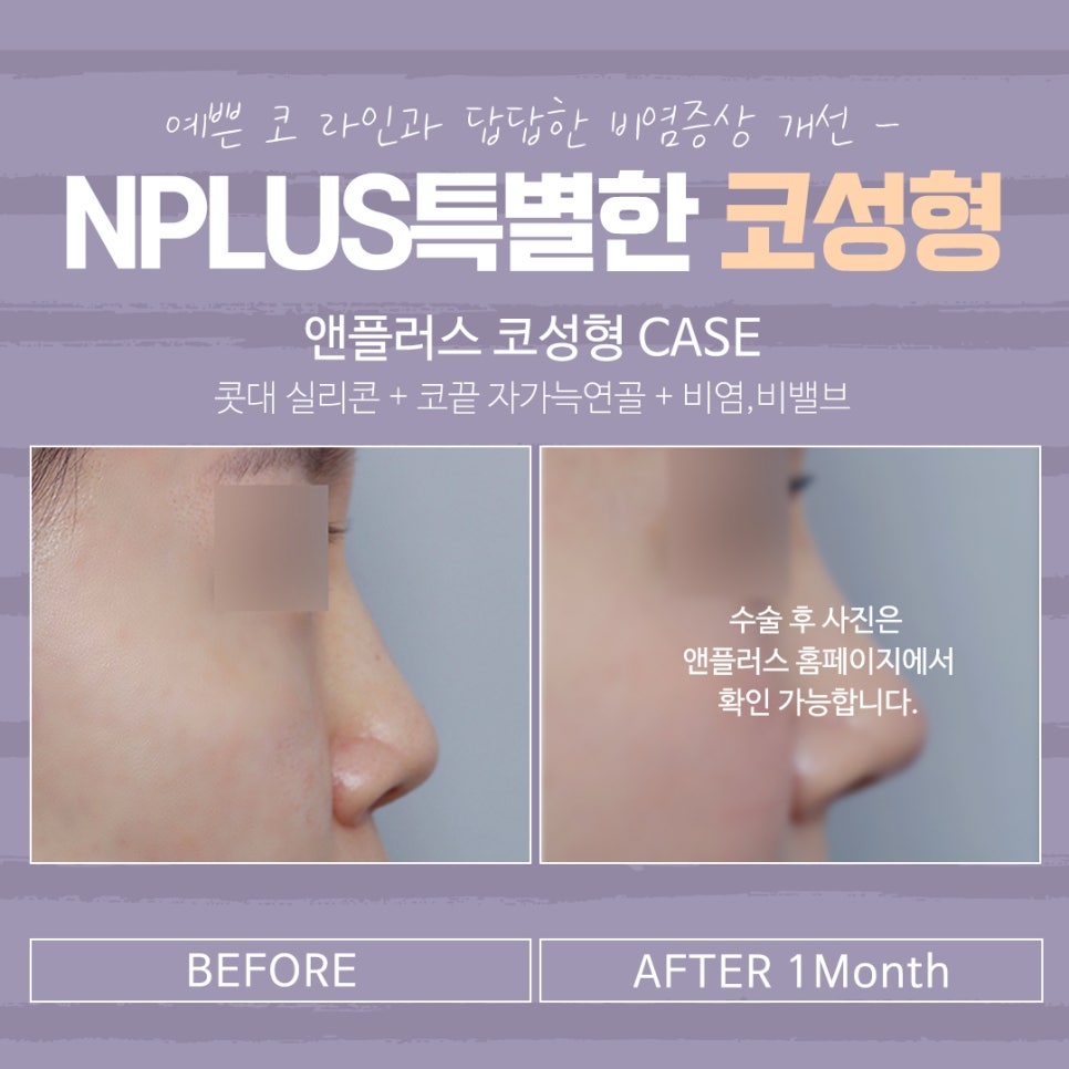 A Nose Surgery Review That Accurately Checks Function Too image 15