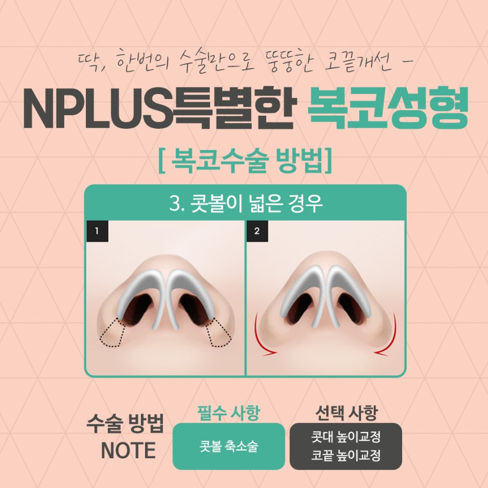 복코성형후기 코지방제거로 확실하게 관련 이미지 9
