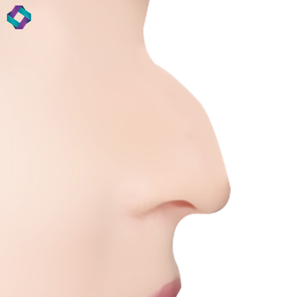 코수술 전후 비교, 앤플러스 매부리코에 대하여 관련 이미지 1