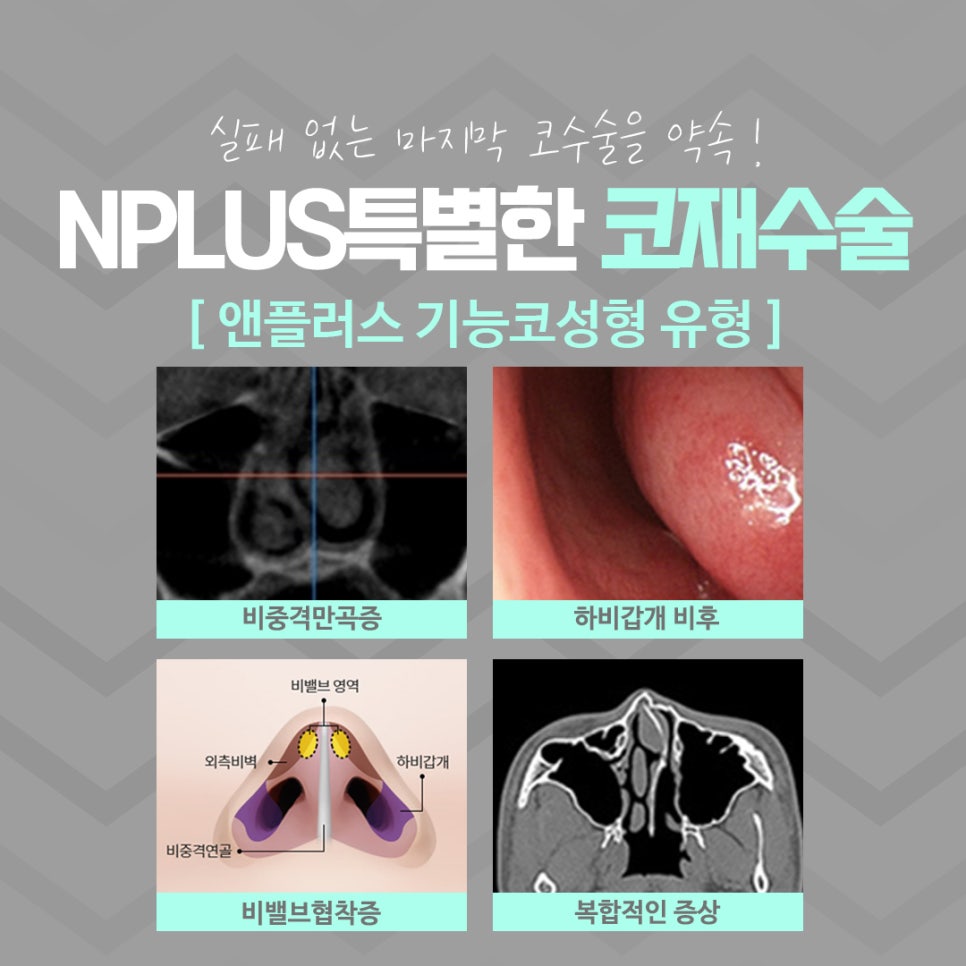 코재수술성형외과 선택의 중요성 관련 이미지 7
