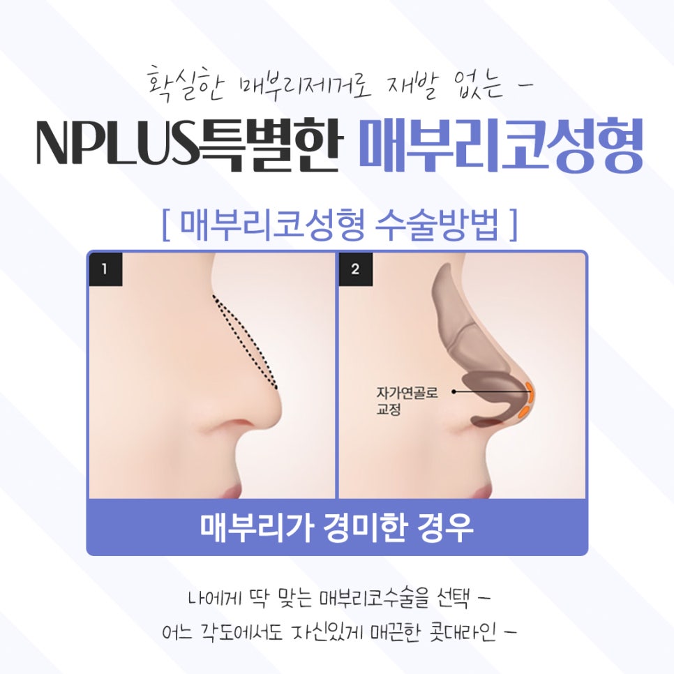 Learn About Hump Nose Surgery Reviews Accurately image 11