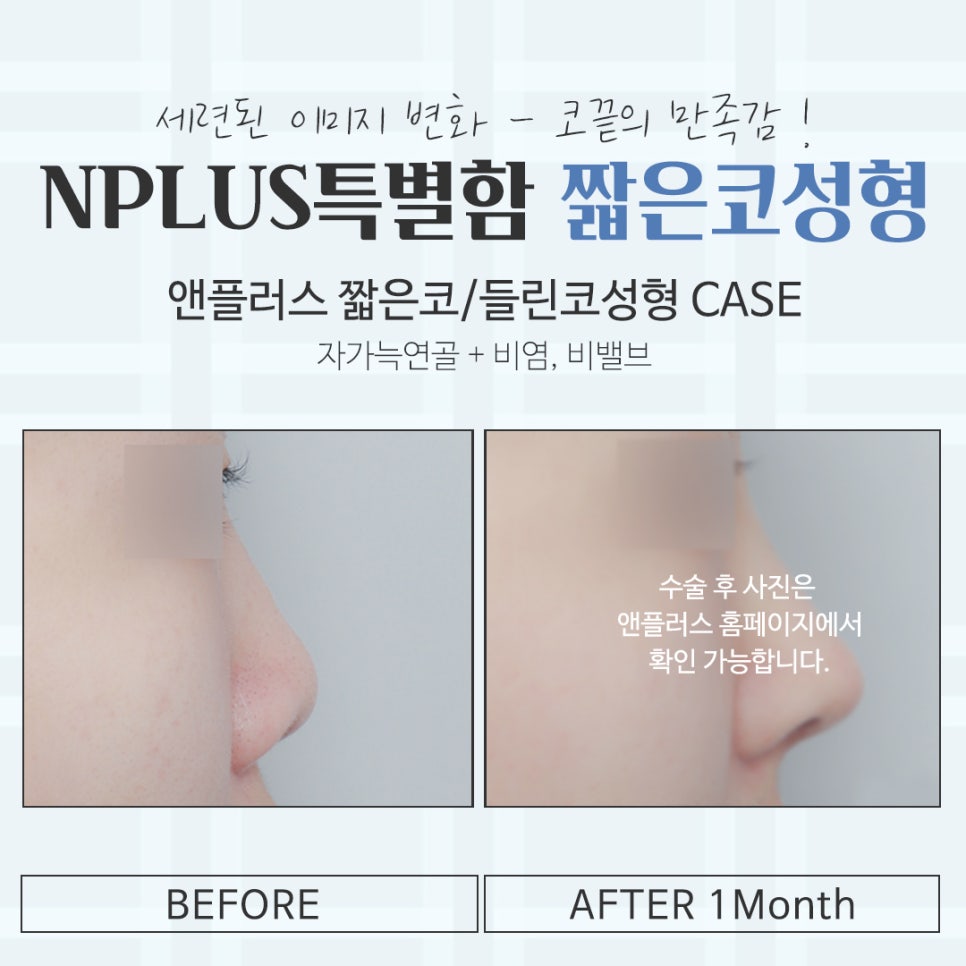 짧은코성형후기 자연스럽고 예쁘게 관련 이미지 14