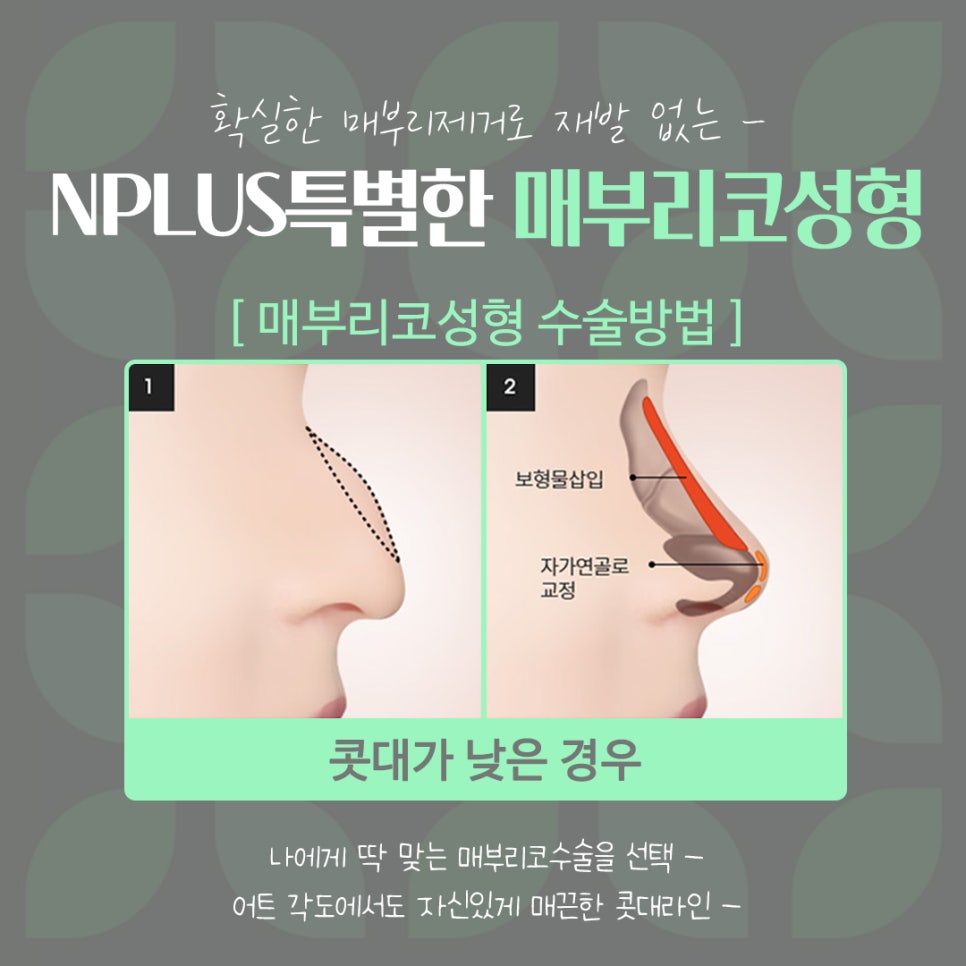Septoplasty and Hump Nose Surgery Review, Considering Function Too image 10