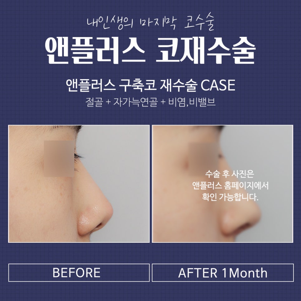 Complete Guide to Revision Rhinoplasty Recovery Period and Surgical Methods image 7