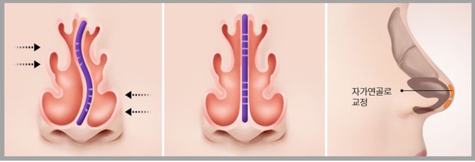 비염코성형? 어렵지 않아요. 관련 이미지 5