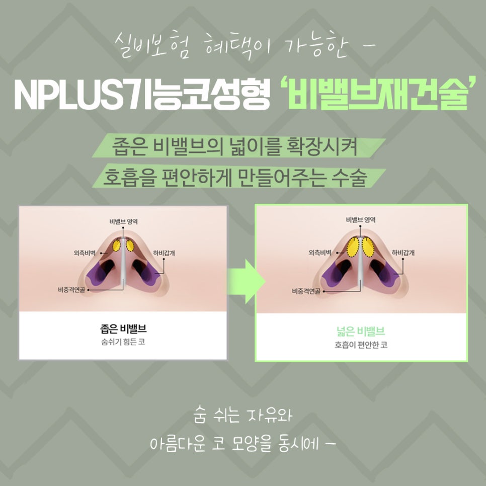 비밸브재건술을 통한 숨 쉬는 자유 관련 이미지 6