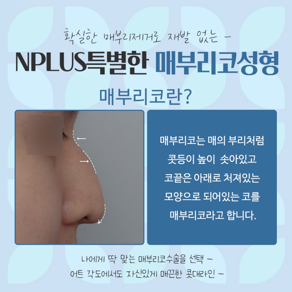남자매부리코 원인을 정확하게 파악하고 관련 이미지 4