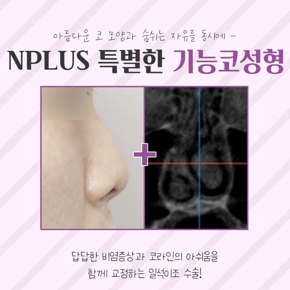Before and After Female Nose Surgery in Various Ways image 4