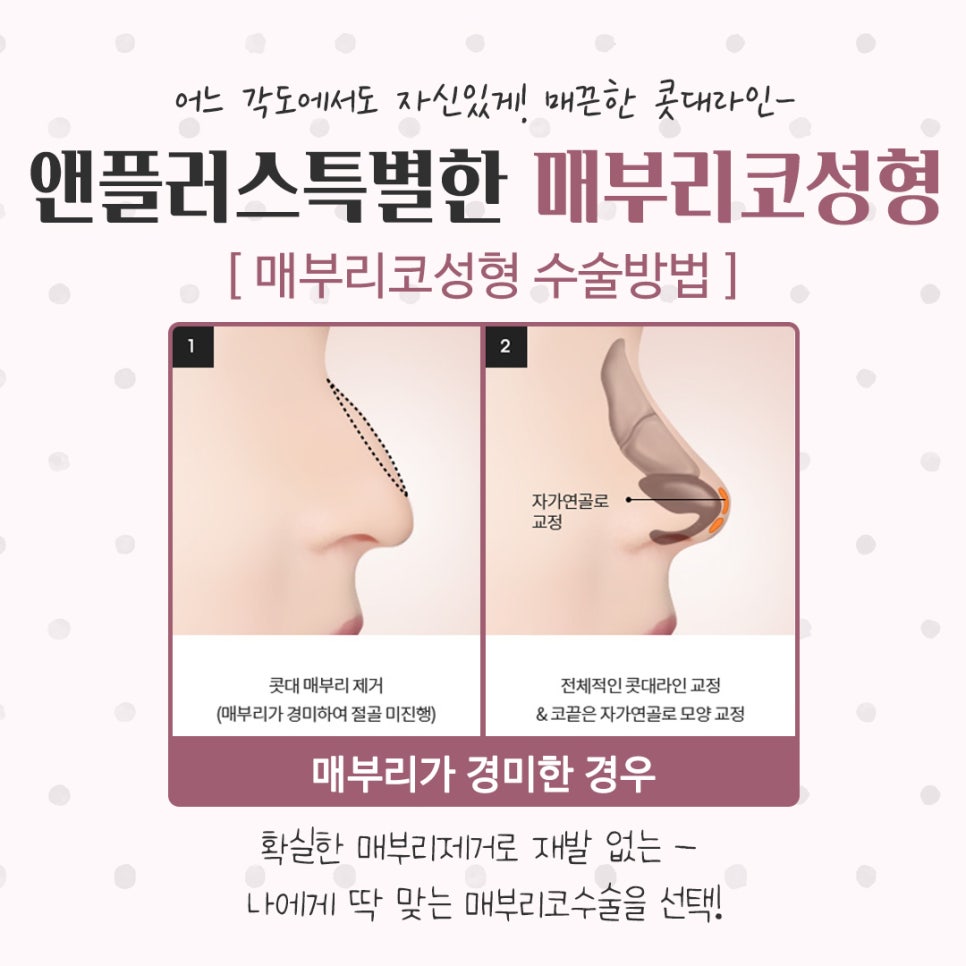 매부리코성형후기 꼼꼼하게 알아보고 관련 이미지 12