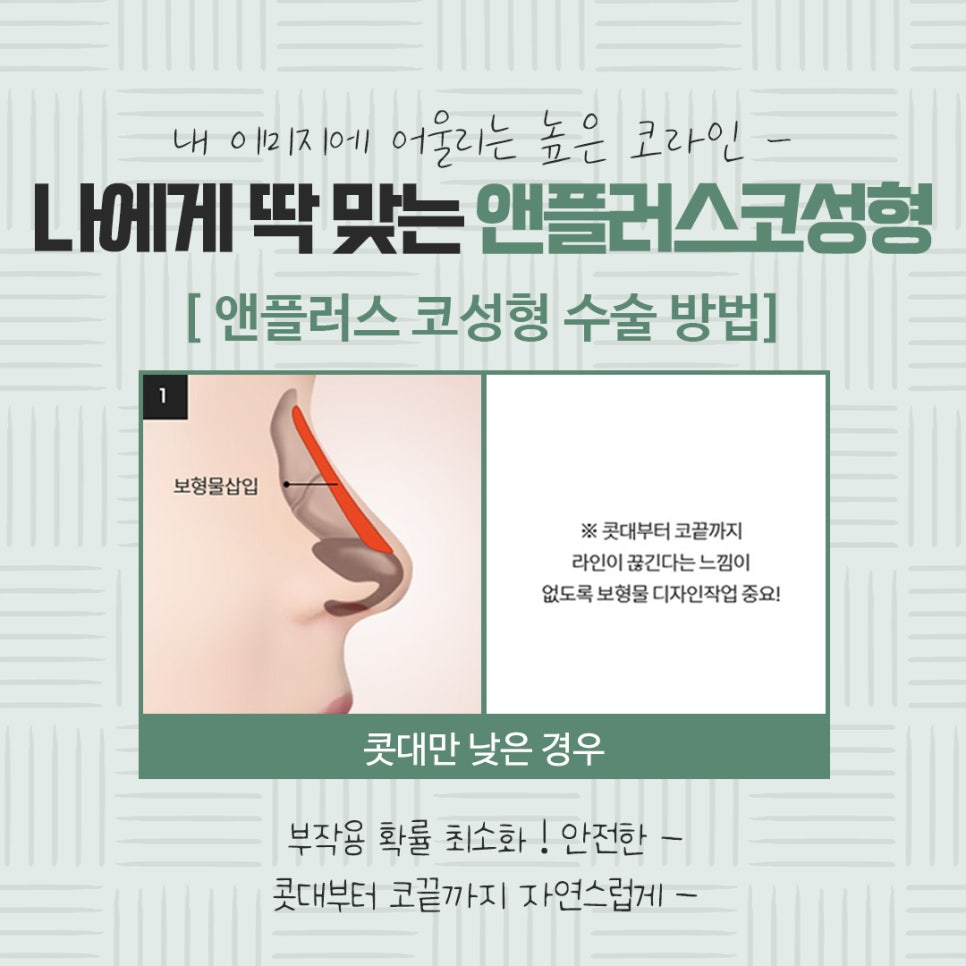 자가연골코수술로 세련되고 자연스럽게 관련 이미지 9