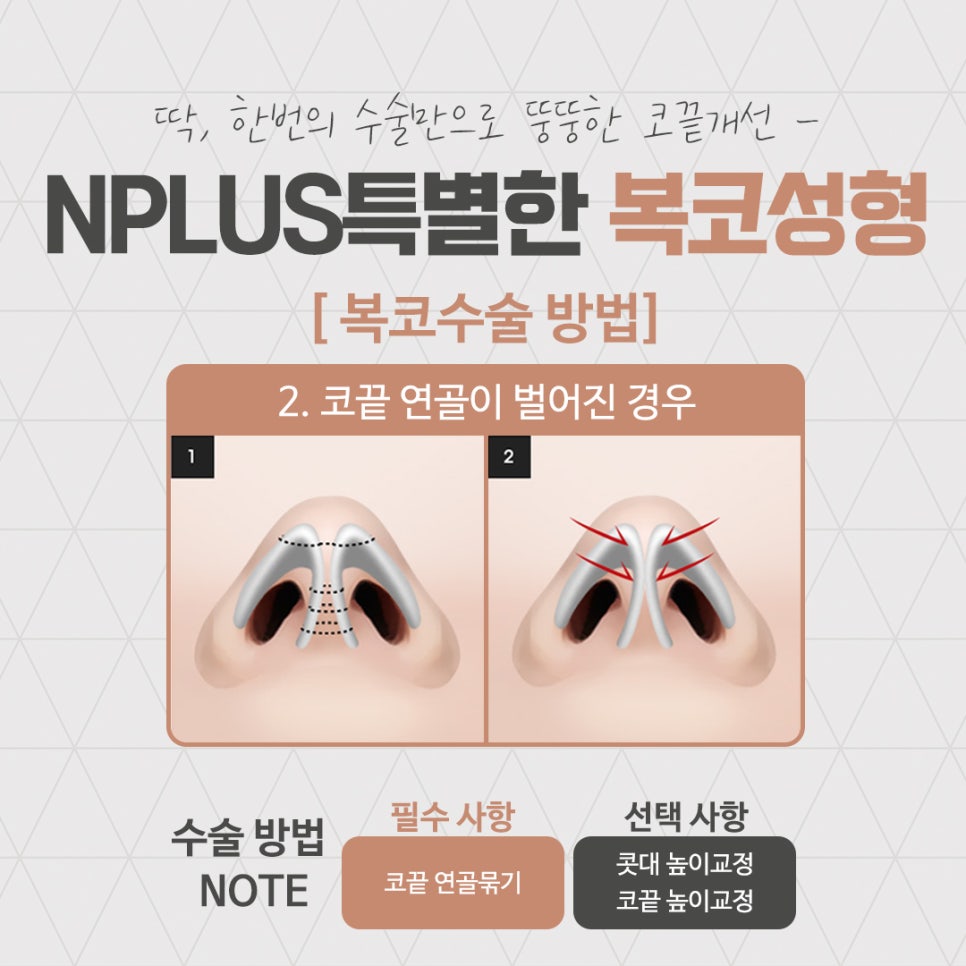 복코성형후기를 다양하게 찾아보고 관련 이미지 9