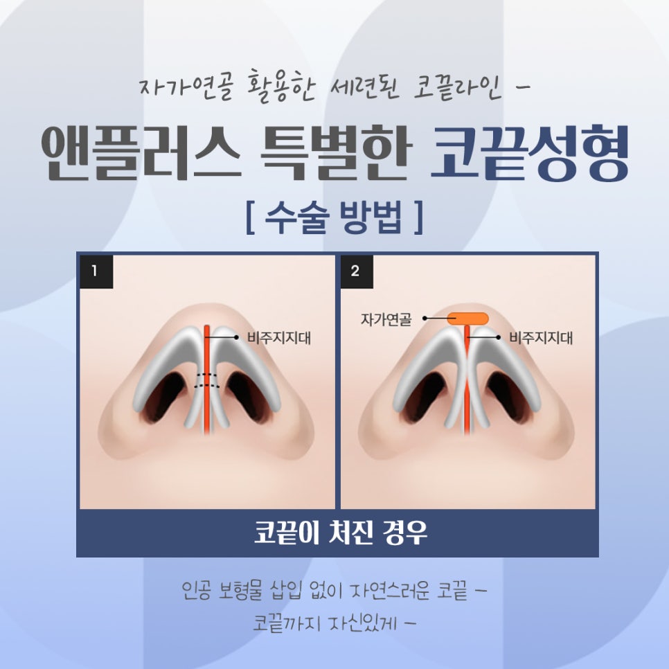 Looking Into Tip Rhinoplasty Reviews in Detail image 10