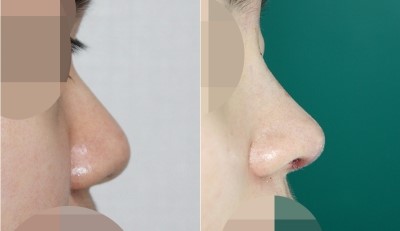 복코성형 (콧대+코끝) 관련 이미지 1