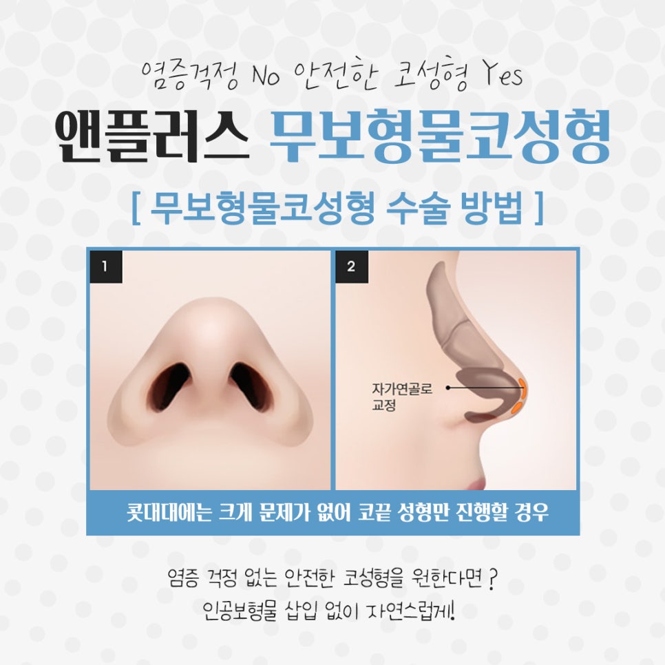 Non-Implant Rhinoplasty: Natural and Safe image 8