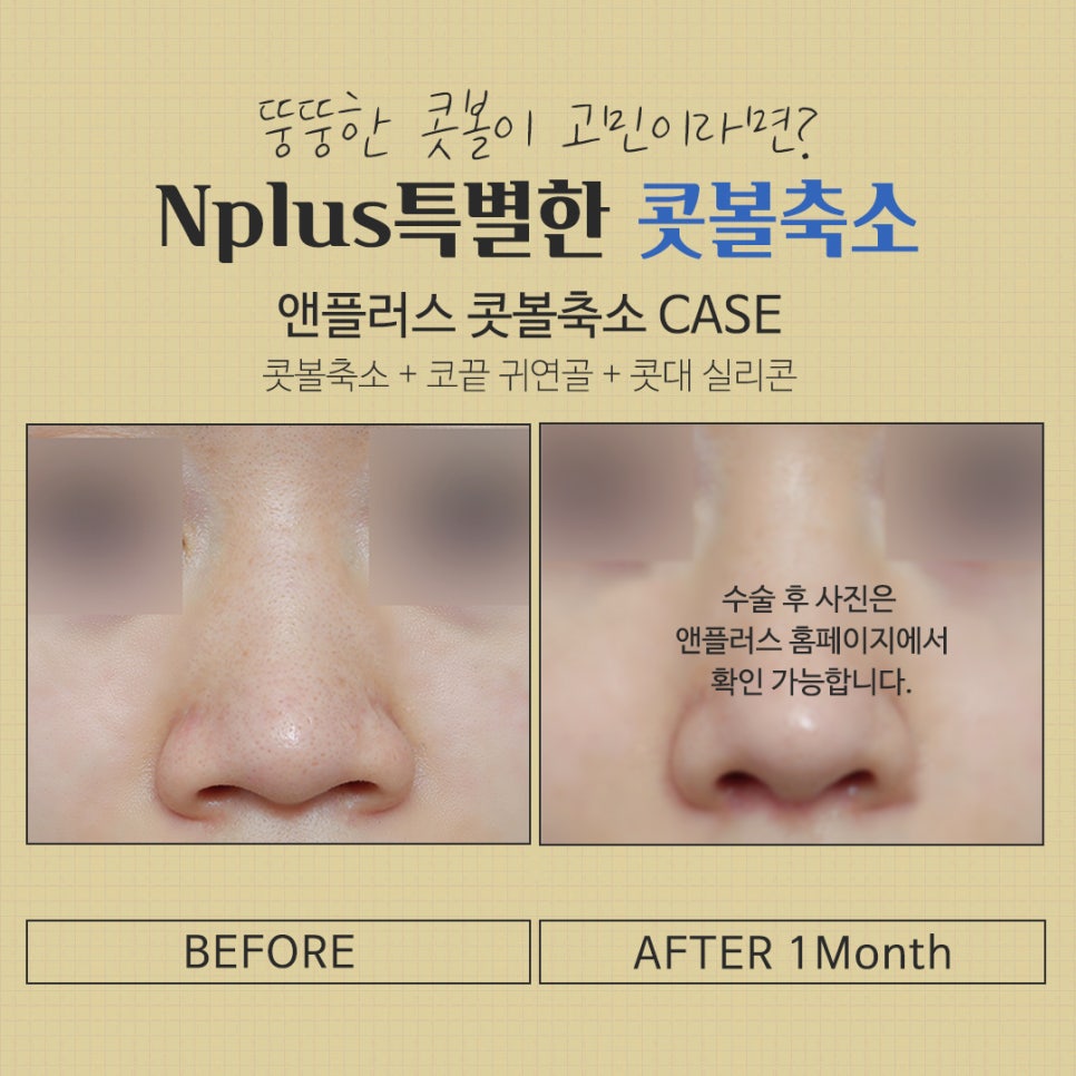 Review of Nostril Reduction to Improve a Wide Nose image 9