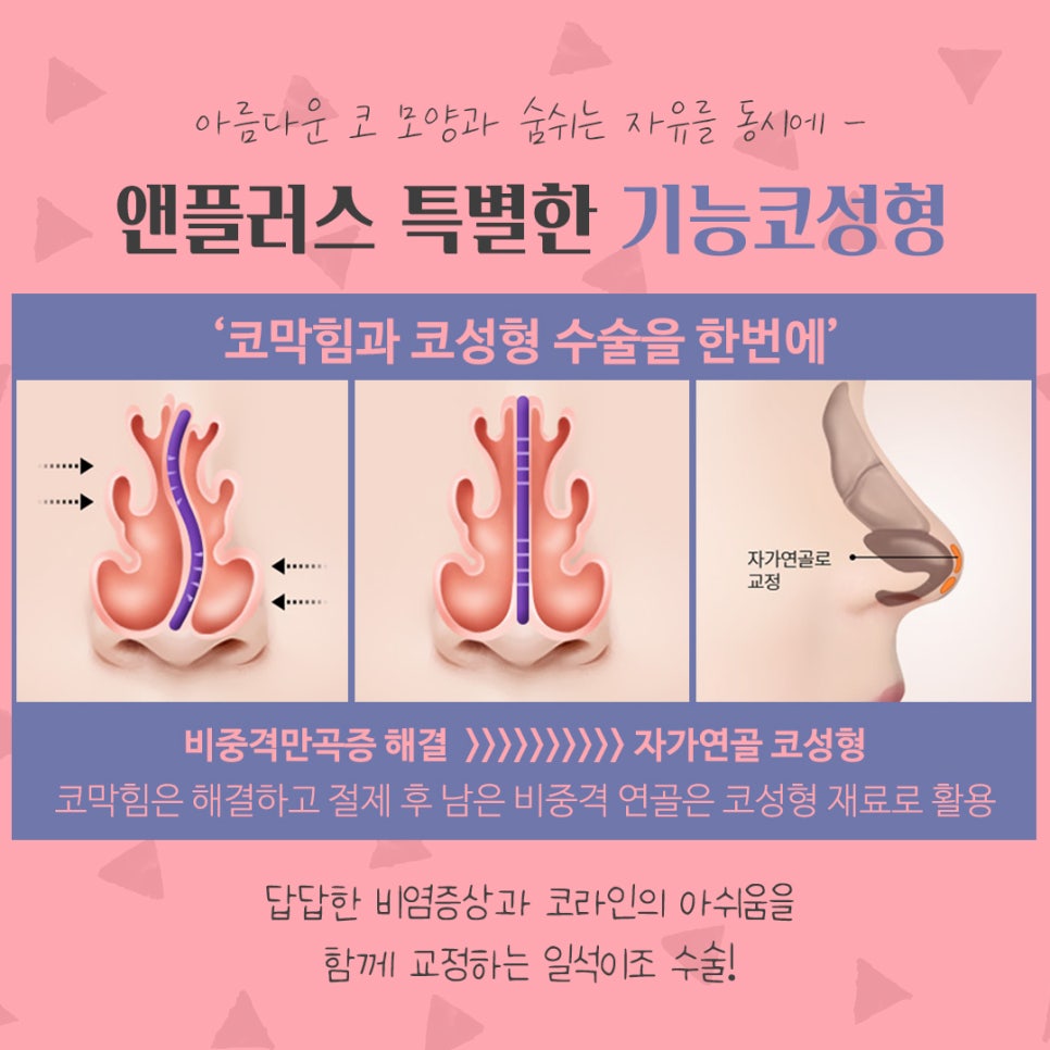 코수술후기 비중격만곡증까지 확인하여 관련 이미지 9