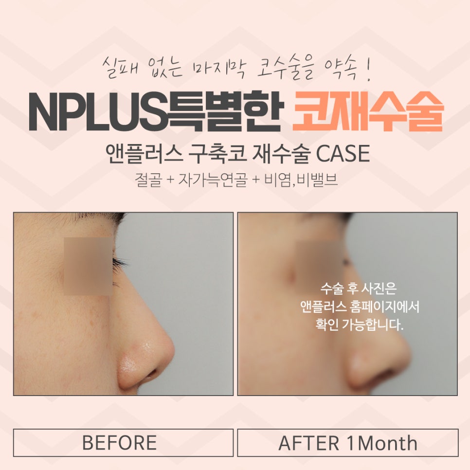 Carefully Looking Into Seoul Nose Revision Surgery image 12