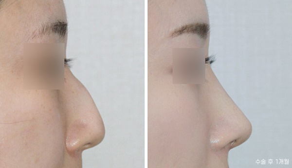 Hump Nose Osteotomy Surgery Review image 3