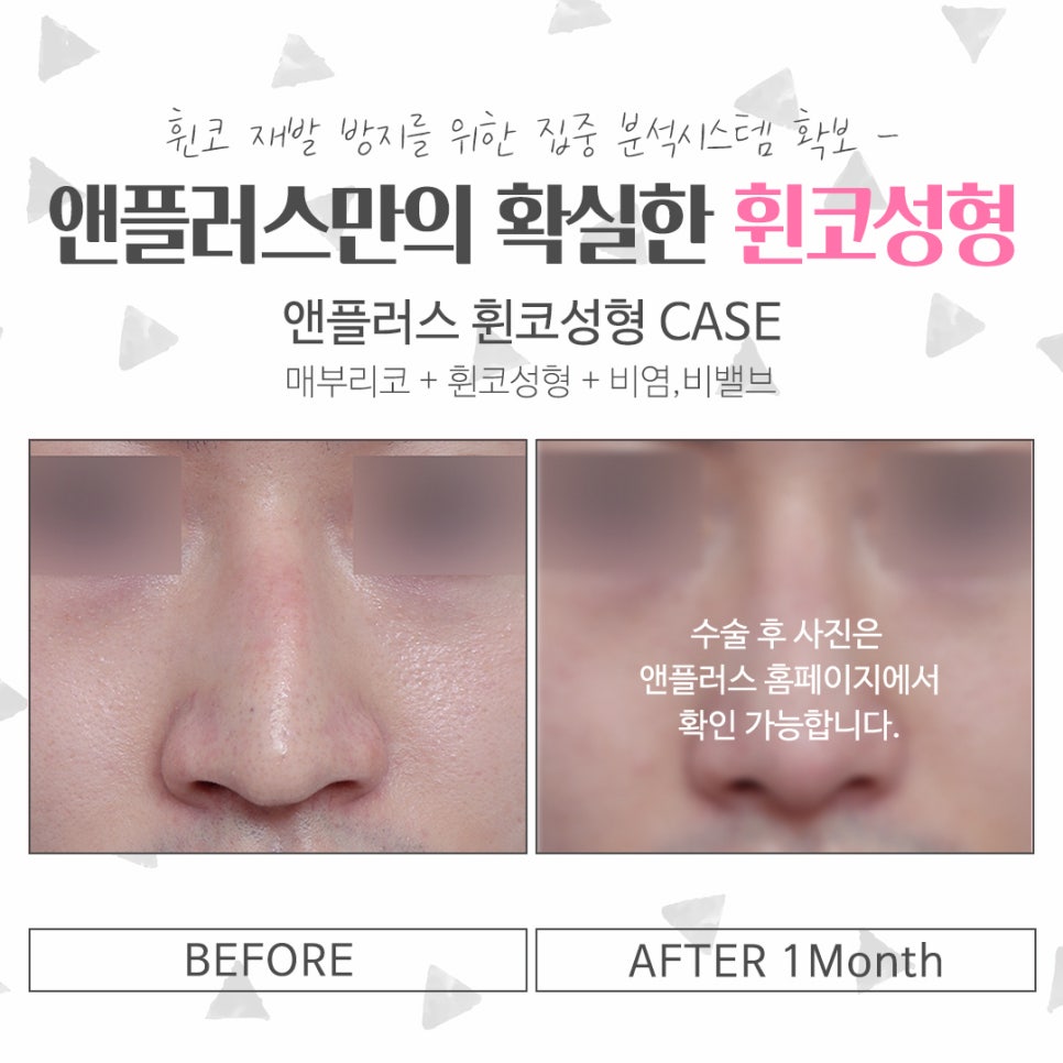 휜코수술후기를 자세하게 알아보고 관련 이미지 13