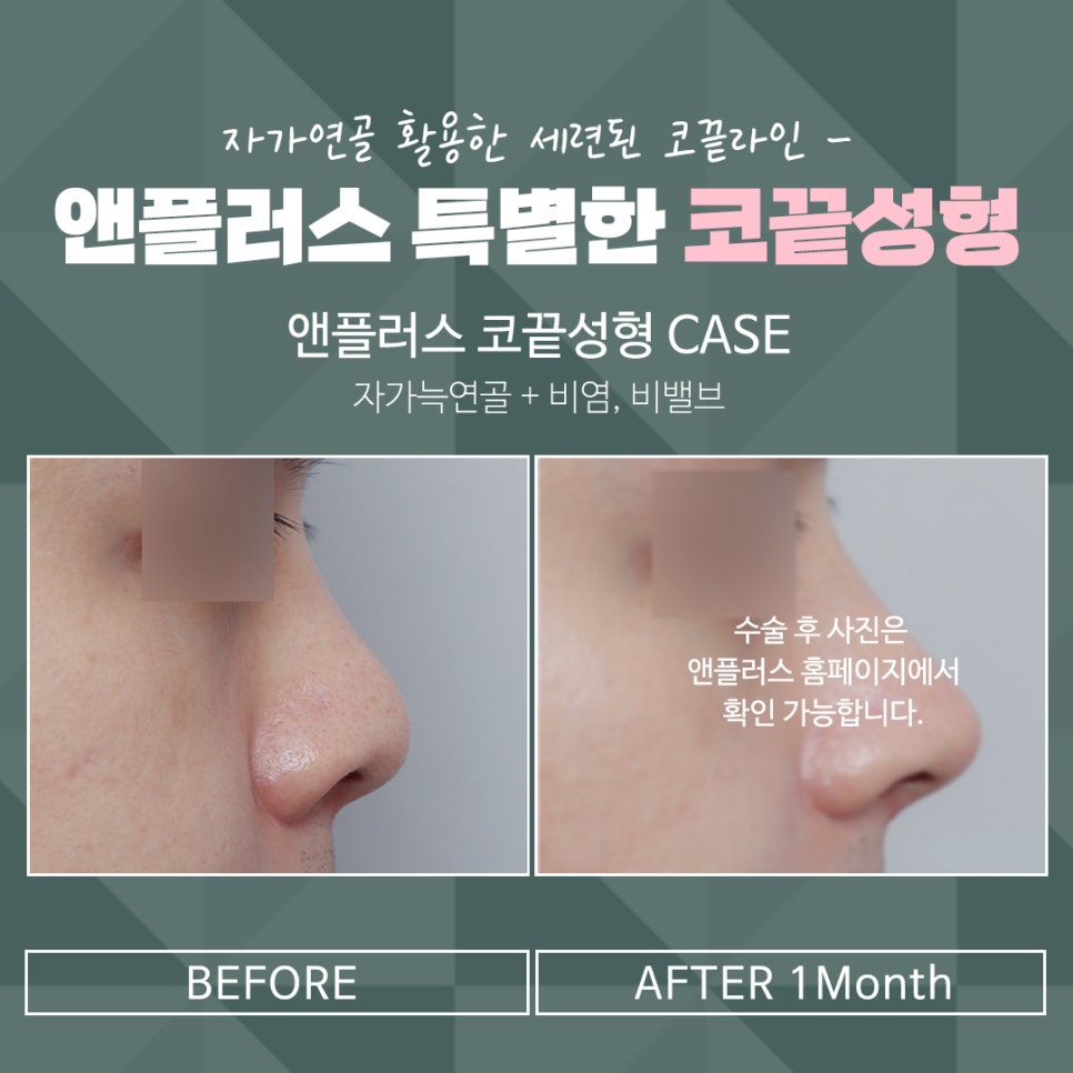 Nasal Tip Surgery Review Using Autologous Cartilage image 17