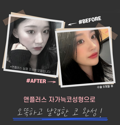 앤플러스의원 자가늑코성형 이벤트😍 관련 이미지 2