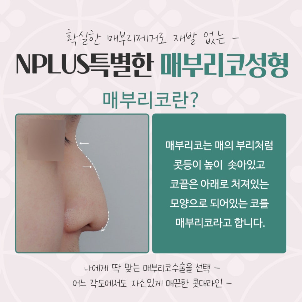 매부리코성형후기 다양한 내용을 찾아보고 관련 이미지 3