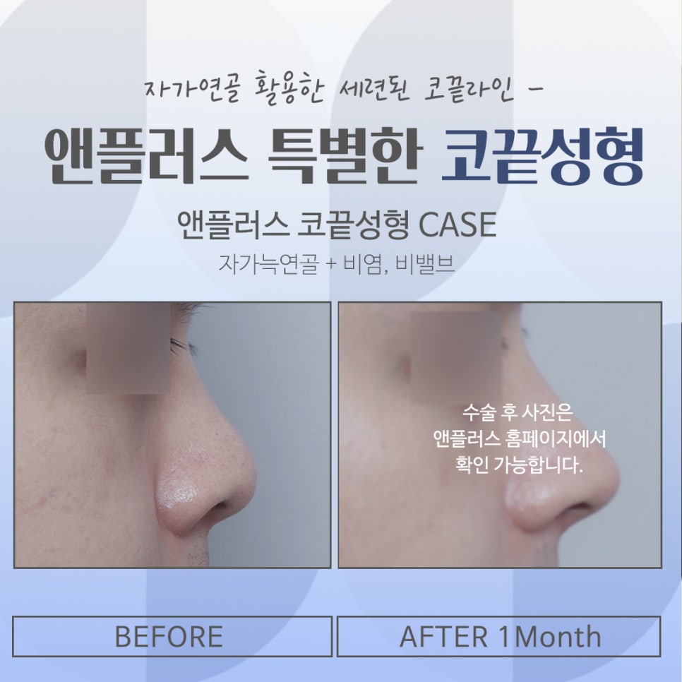 Looking Into Tip Rhinoplasty Reviews in Detail image 16