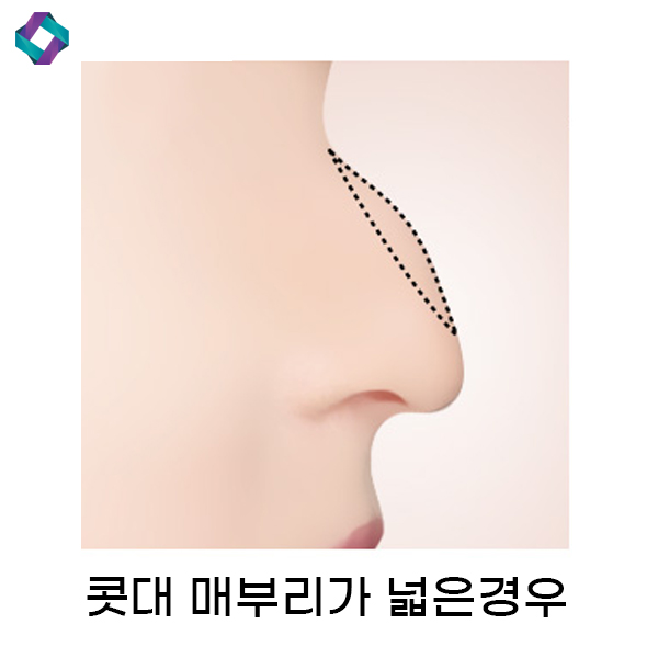 코수술 전후 비교, 앤플러스 매부리코에 대하여 관련 이미지 4