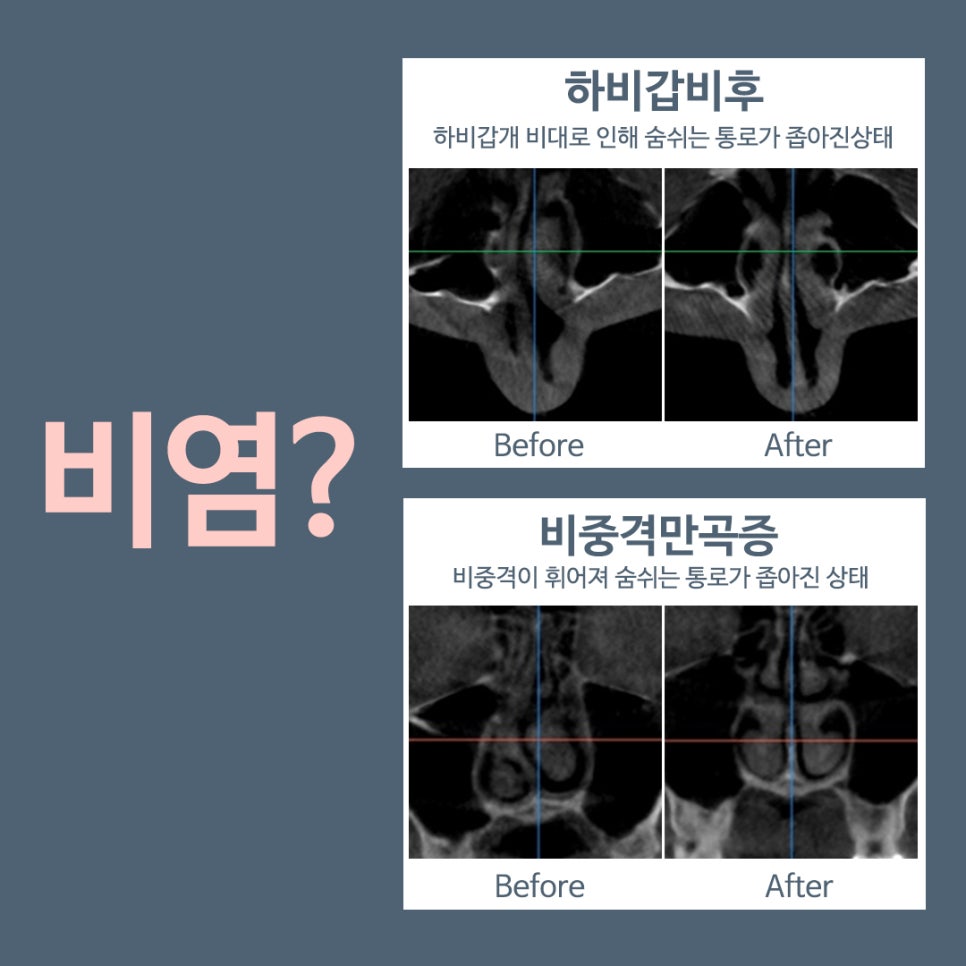 Analyzing the Causes of Rhinitis Surgery to Full Recovery image 3