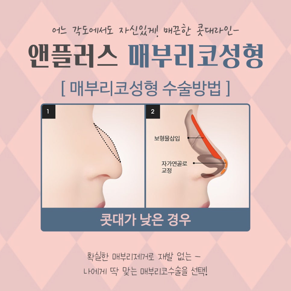 A Smooth Nasal Bridge Line Through Hump Nose Correction image 9