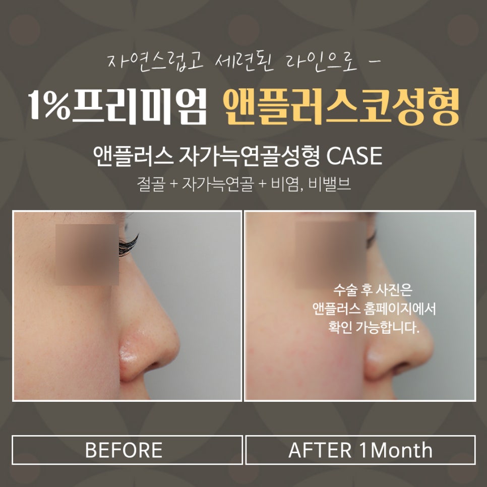 자가늑연골코성형으로 세련된 이미지로 변신 관련 이미지 7
