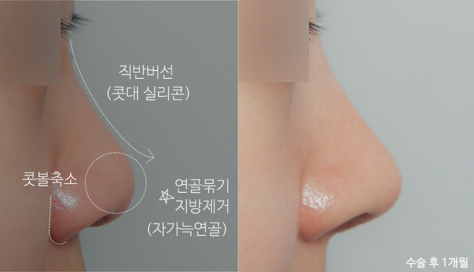 낮은코성형 비염수술도 예쁘게 관련 이미지 6