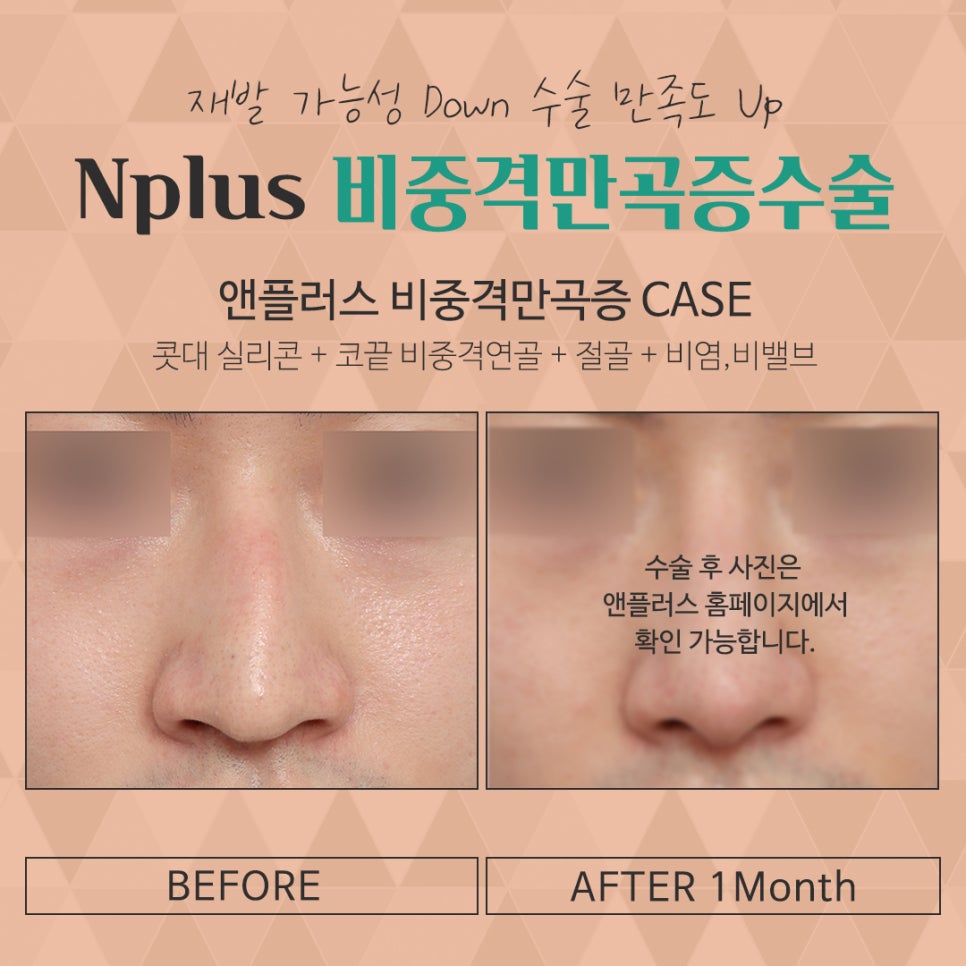 비중격만곡증수술 꼼꼼하게 알아보고 관련 이미지 12