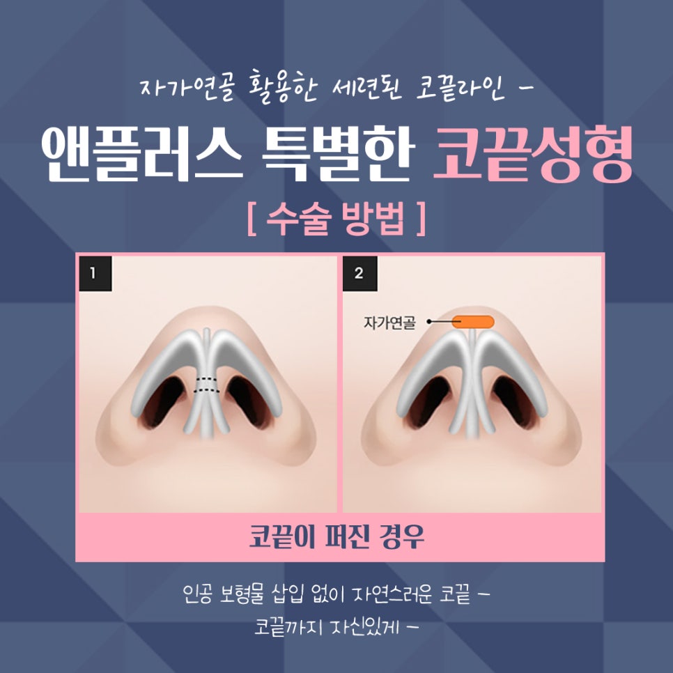 Nose Tip Surgery Review Using Tip Cartilage Suturing image 12