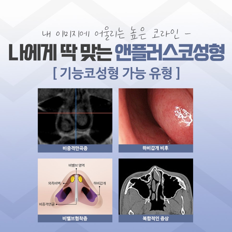 압구정코성형에서 자연스럽게 개선 관련 이미지 5
