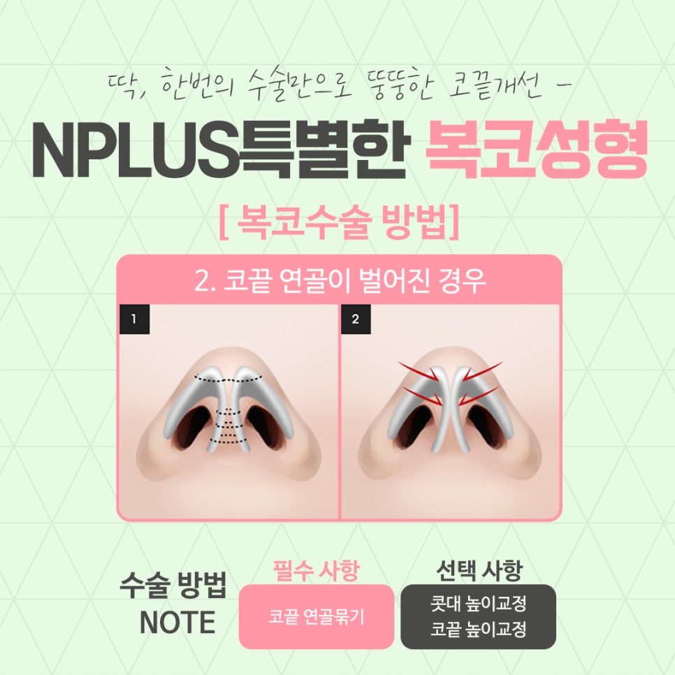 Before and After Bulbous Nose Surgery: Accurately Identifying the Cause image 8