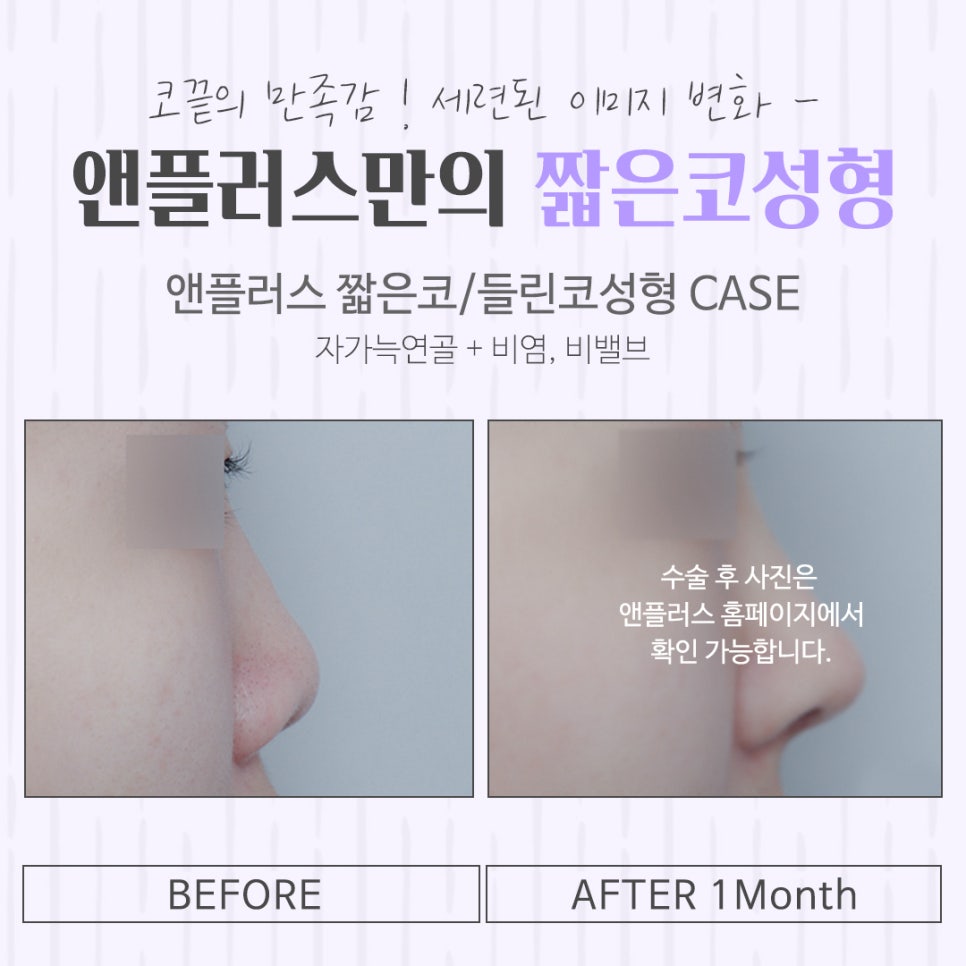 짧은코수술 후기까지 확실하게 관련 이미지 15