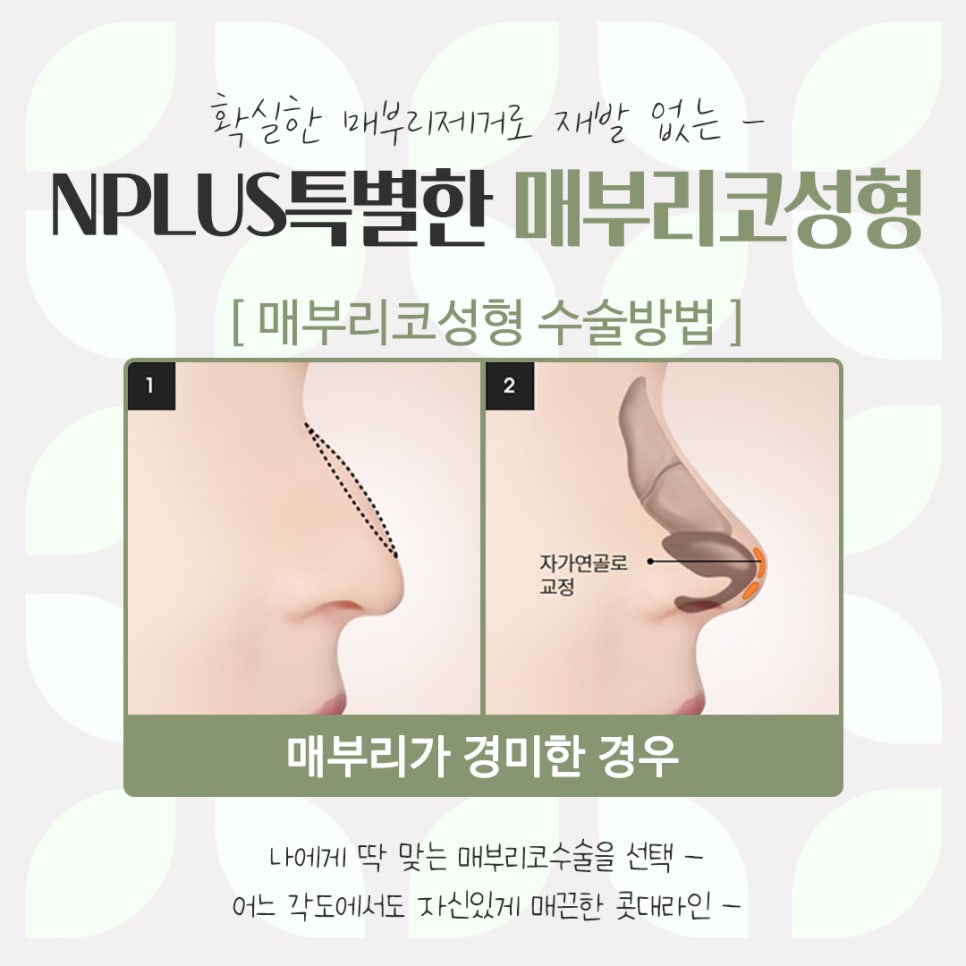 Detailed Hump Nose Surgery Review image 12