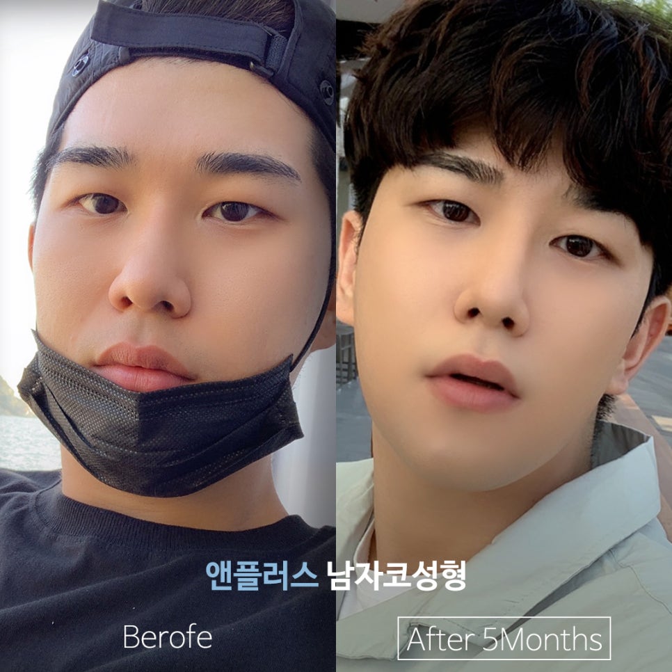 남자코성형후기 기능까지 추가하여 관련 이미지 7
