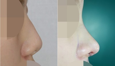 앤플러스 비염수술 : 미용코성형, 비중격만곡증 전후사진 관련 이미지 1